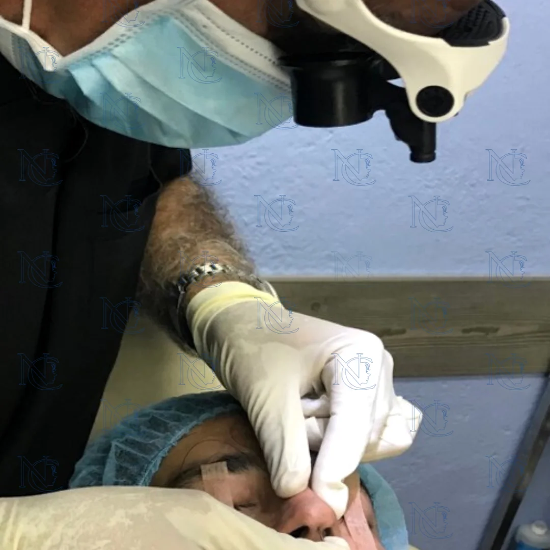 Durante el Procedimiento de Rinomodelacion en Nueva Cara Sin Cirugía