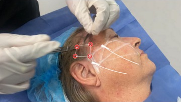 Tratamientos de lifting facial Cuernavaca | Rejuvenecimiento de piel sin cirugía | Especialista en lifting facial Cuernavaca | Procedimientos estéticos personalizados Morelos